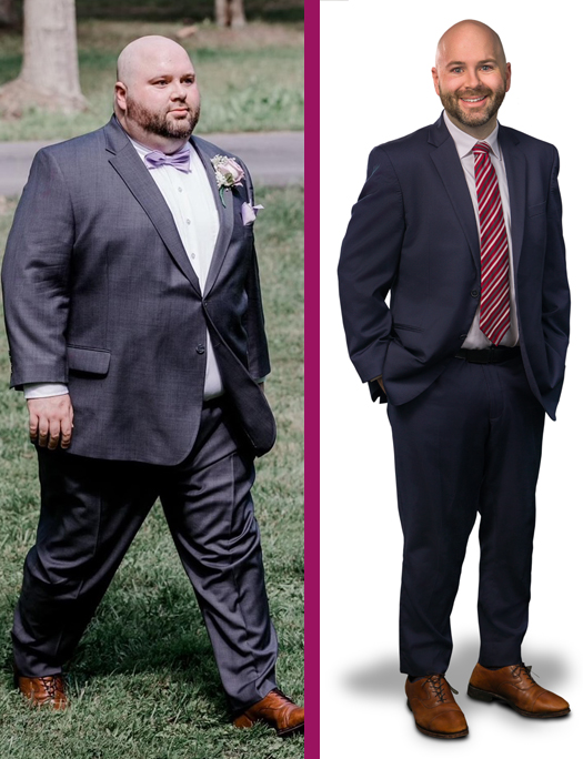 Andrew's Bariatric Surgery Before and After photo