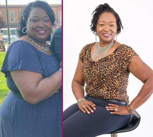 Dorothy's Bariatric Surgery Before and After