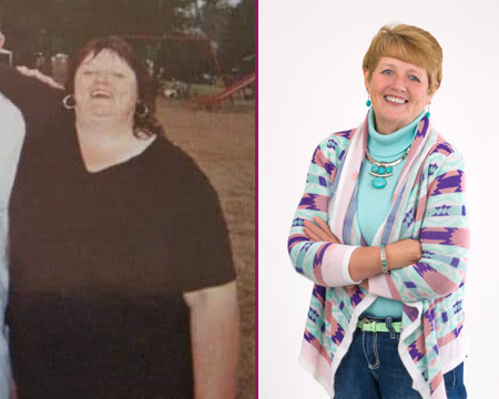 Kathy's Bariatric Surgery Before and After photo