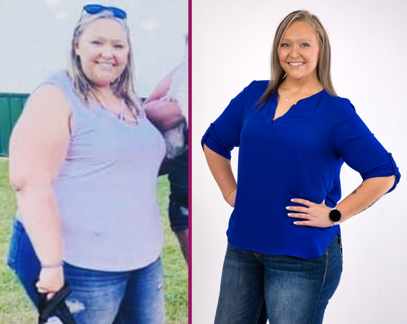 Mackenzie's Sleeve Gastrectomy Before and After photo